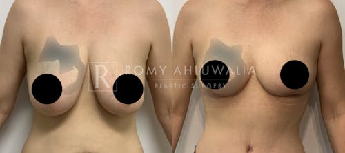 Before & After Result of Breast Reduction Patient #42