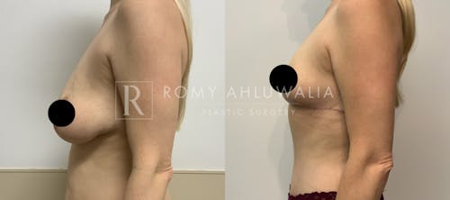 Before & After Result of Breast Reduction Patient #42