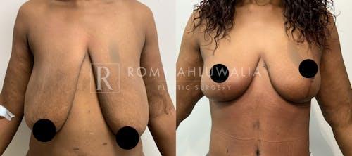 Before & After Result of Breast Reduction Patient #41