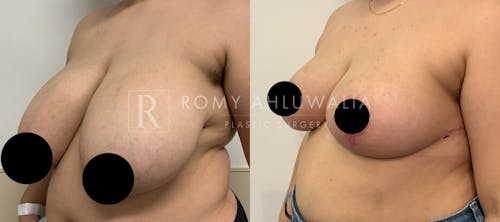 Before & After Result of Breast Reduction Patient #39
