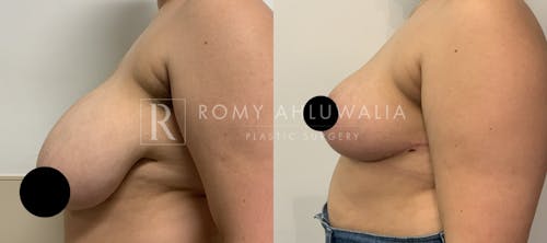 Before & After Result of Breast Reduction Patient #39