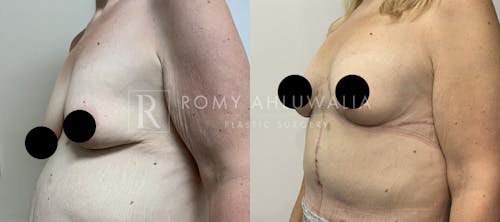 Before & After Result of Breast Reduction Patient #38