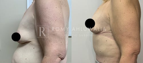 Before & After Result of Breast Reduction Patient #38