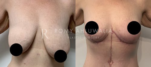 Before & After Result of Breast Reduction Patient #37