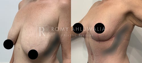 Before & After Result of Breast Reduction Patient #37