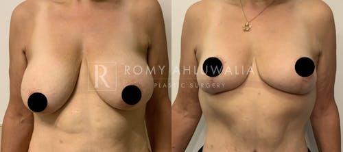 Before & After Result of Breast Reduction Patient #36