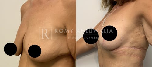 Before & After Result of Breast Reduction Patient #35