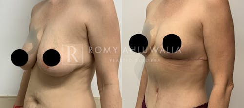 Before & After Result of Breast Reduction Patient #42