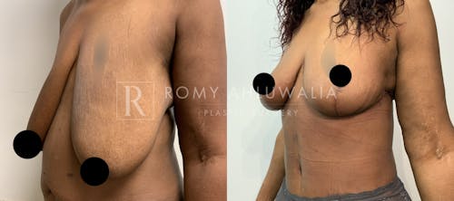Before & After Result of Breast Reduction Patient #41