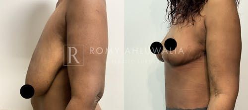 Before & After Result of Breast Reduction Patient #41