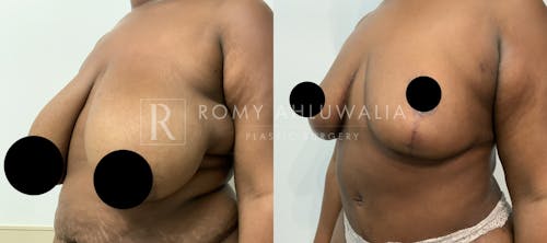 Before & After Result of Breast Reduction Patient #40