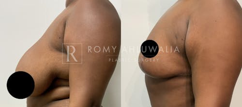 Before & After Result of Breast Reduction Patient #40