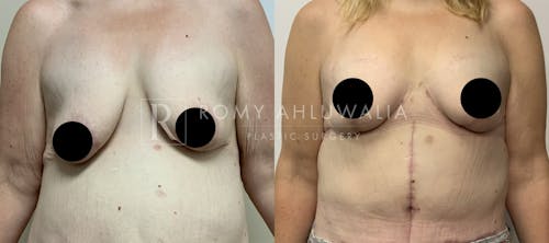Before & After Result of Breast Reduction Patient #38