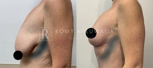 Before & After Result of Breast Reduction Patient #37
