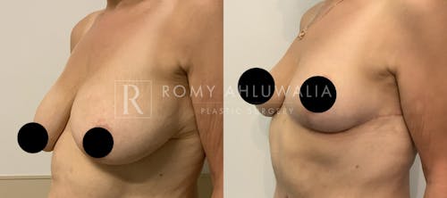 Before & After Result of Breast Reduction Patient #36