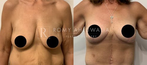 Before & After Result of Breast Reduction Patient #35