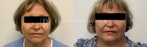 Before & After Result of Mini Facelift Patient #22