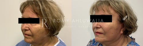 Before & After Result of Mini Facelift Patient #22