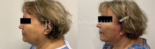 Before & After Result of Mini Facelift Patient #22