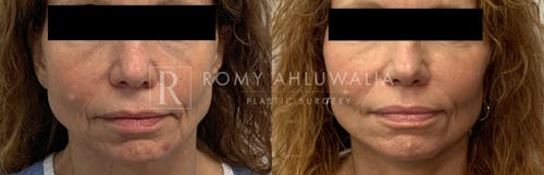 Before & After Result of Mini Facelift Patient #23