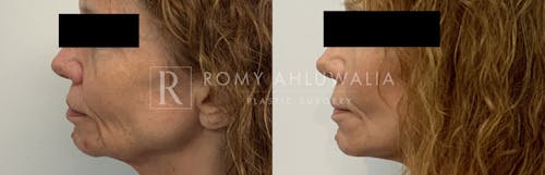 Before & After Result of Mini Facelift Patient #23
