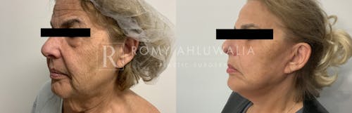 Before & After Result of Facelift Patient #24
