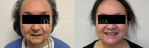 Before & After Result of Facelift Patient #25