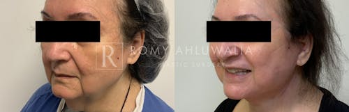 Before & After Result of Facelift Patient #25