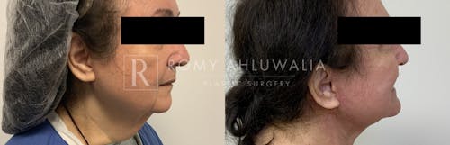 Before & After Result of Facelift Patient #25