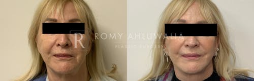 Before & After Result of Facelift Patient #26