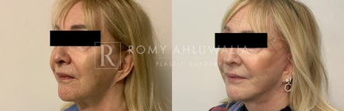 Before & After Result of Facelift Patient #26