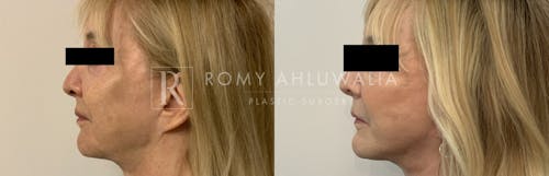 Before & After Result of Facelift Patient #26