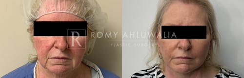 Before & After Result of Facelift Patient #27