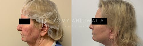 Before & After Result of Facelift Patient #27