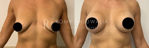 Before & After Result of Breast Augmentation Patient #21