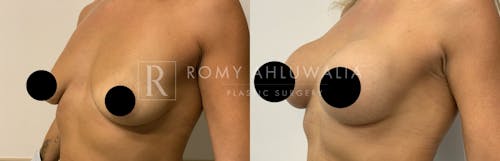 Before & After Result of Breast Augmentation Patient #21