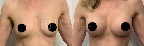 Before & After Result of Breast Augmentation Patient #22