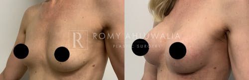 Before & After Result of Breast Augmentation Patient #22