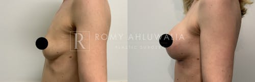 Before & After Result of Breast Augmentation Patient #22