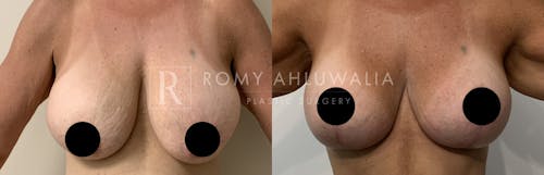 Before & After Result of Breast Augmentation With Lift Patient #3
