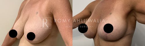 Before & After Result of Breast Augmentation With Lift Patient #3