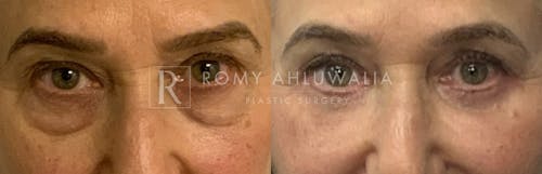 Before & After Result of Lower Eyelid Surgery Patient #17