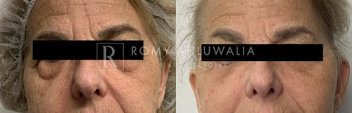Before & After Result of Lower Eyelid Surgery Patient #18