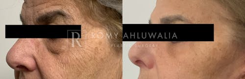 Before & After Result of Lower Eyelid Surgery Patient #18