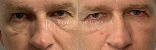 Before & After Result of Lower Eyelid Surgery Patient #16