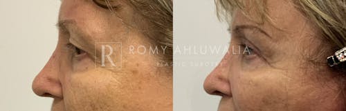 Before & After Result of Upper Eyelid Surgery Patient #19