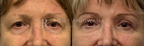 Before & After Result of Upper Eyelid Surgery Patient #19