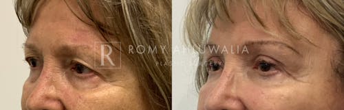 Before & After Result of Upper Eyelid Surgery Patient #19