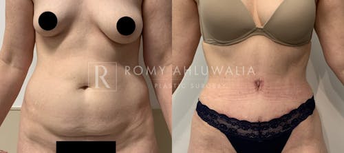 Before & After Result of Tummy Tuck Patient #70
