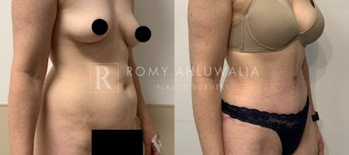Before & After Result of Tummy Tuck Patient #70